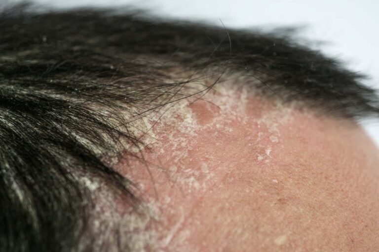 psoriasis on the hairline and on the scalp-close up, dermatological diseases, skin problems